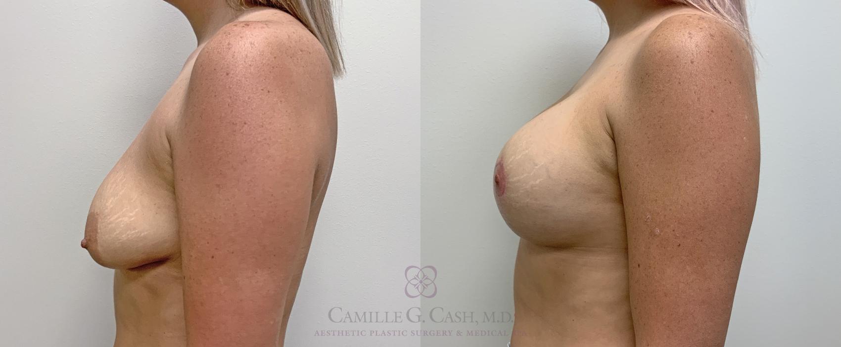 Before & After Breast Lift with Implants Case 454 Right Side View in Houston, TX