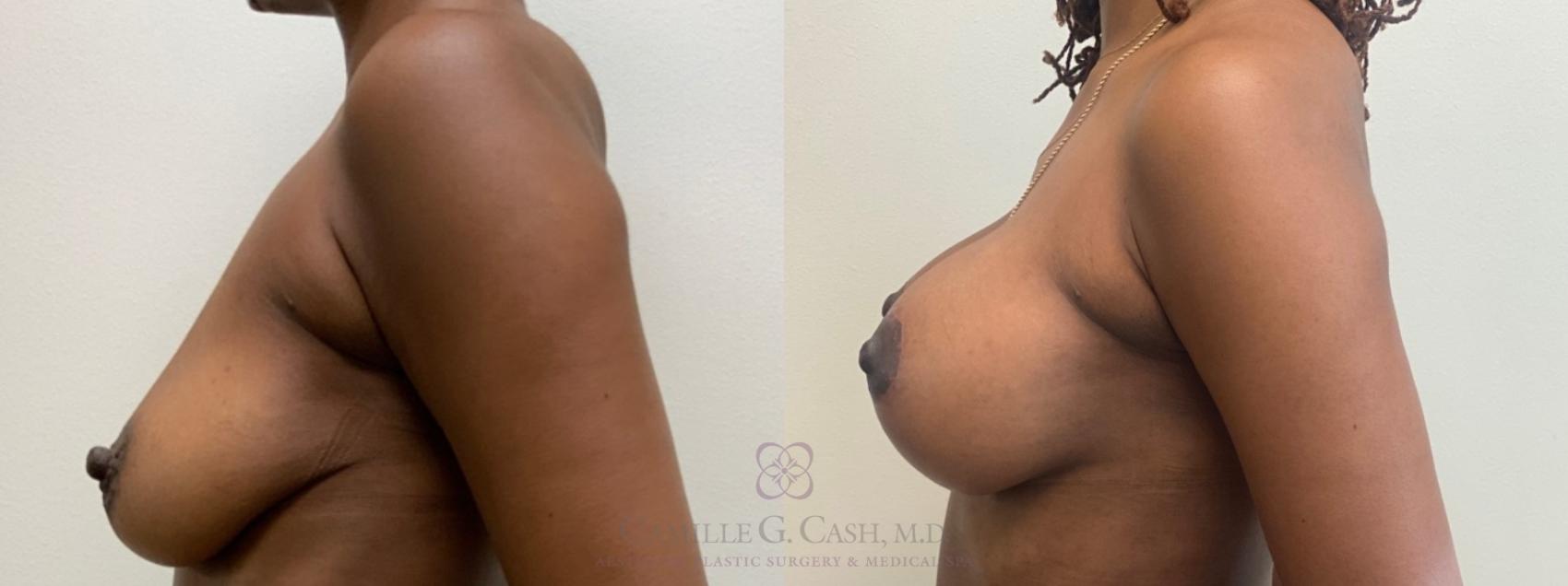 Before & After Breast Lift with Implants Case 478 Right Side View in Houston, TX