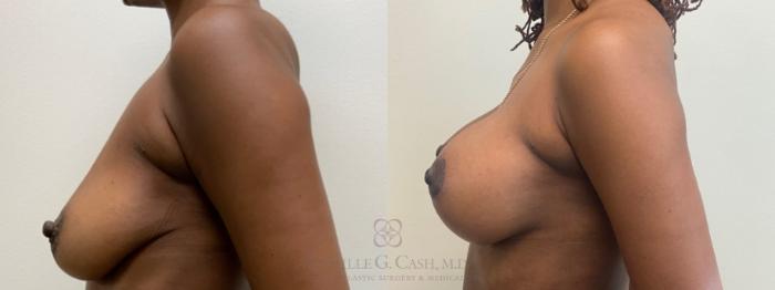Before & After Breast Lift with Implants Case 478 Right Side View in Houston, TX