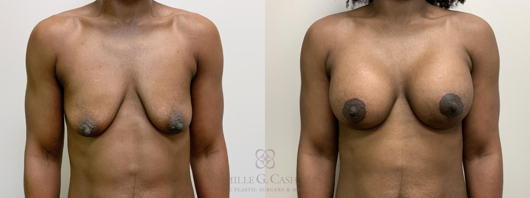 Before & After Breast Lift with Implants Case 485 Front View in Houston, TX