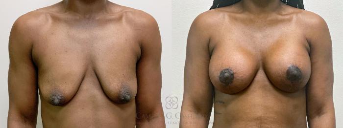 Before & After Breast Lift with Implants Case 485 front8 weeks View in Houston, TX