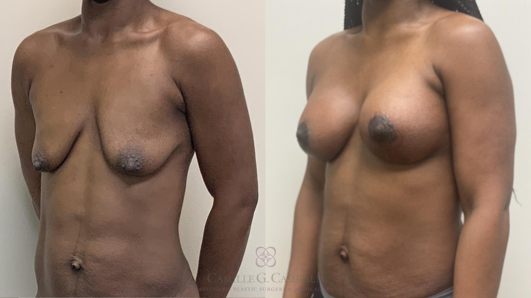 Before & After Breast Lift with Implants Case 485 left ob 8 week View in Houston, TX