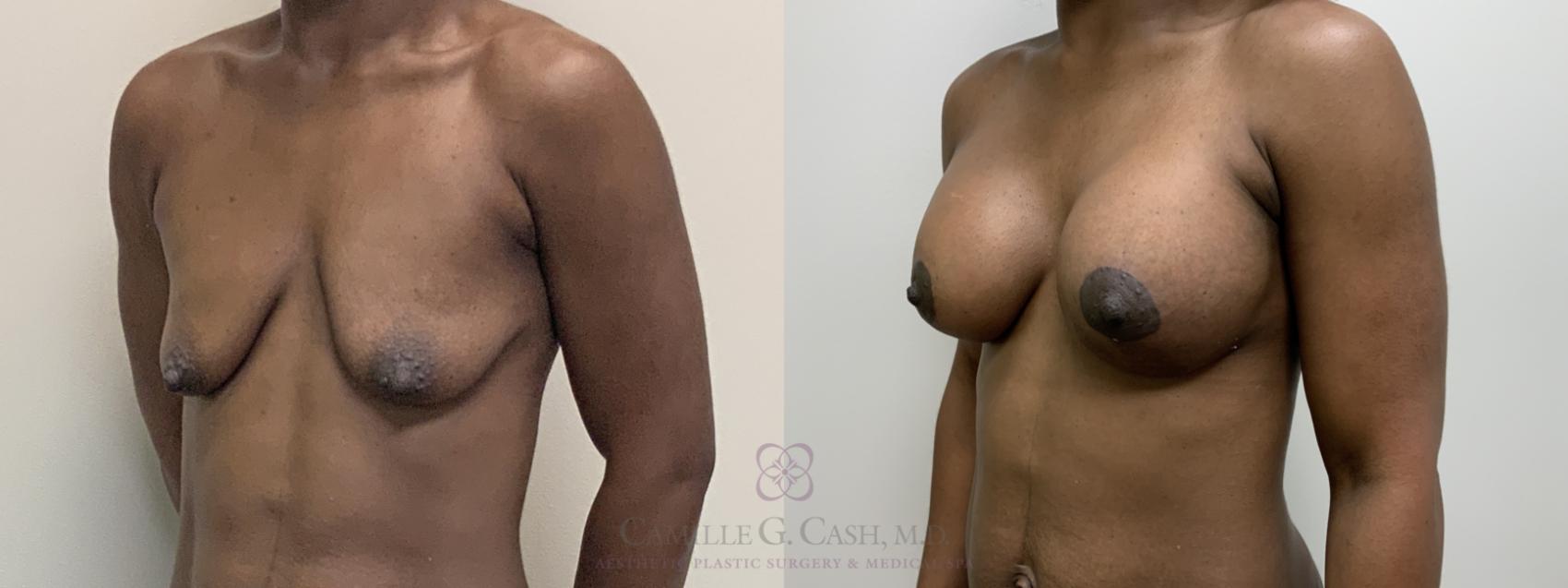 Before & After Breast Lift with Implants Case 485 Left Oblique View in Houston, TX