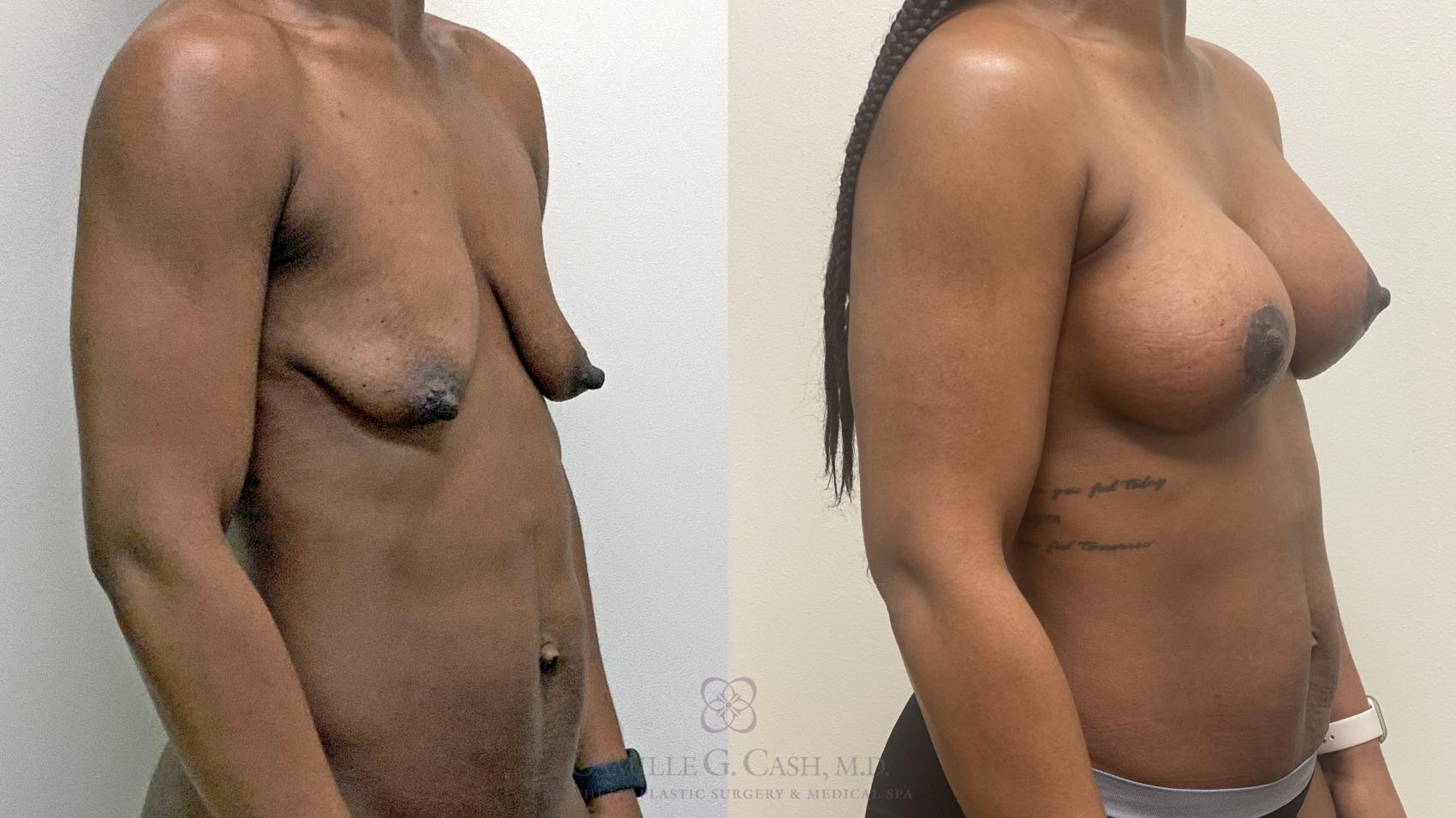 Before & After Breast Lift with Implants Case 485 ob 8 week View in Houston, TX