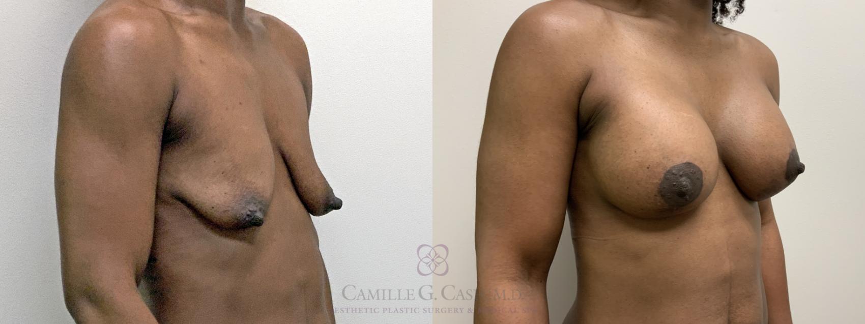 Before & After Breast Lift with Implants Case 485 Right Oblique View in Houston, TX