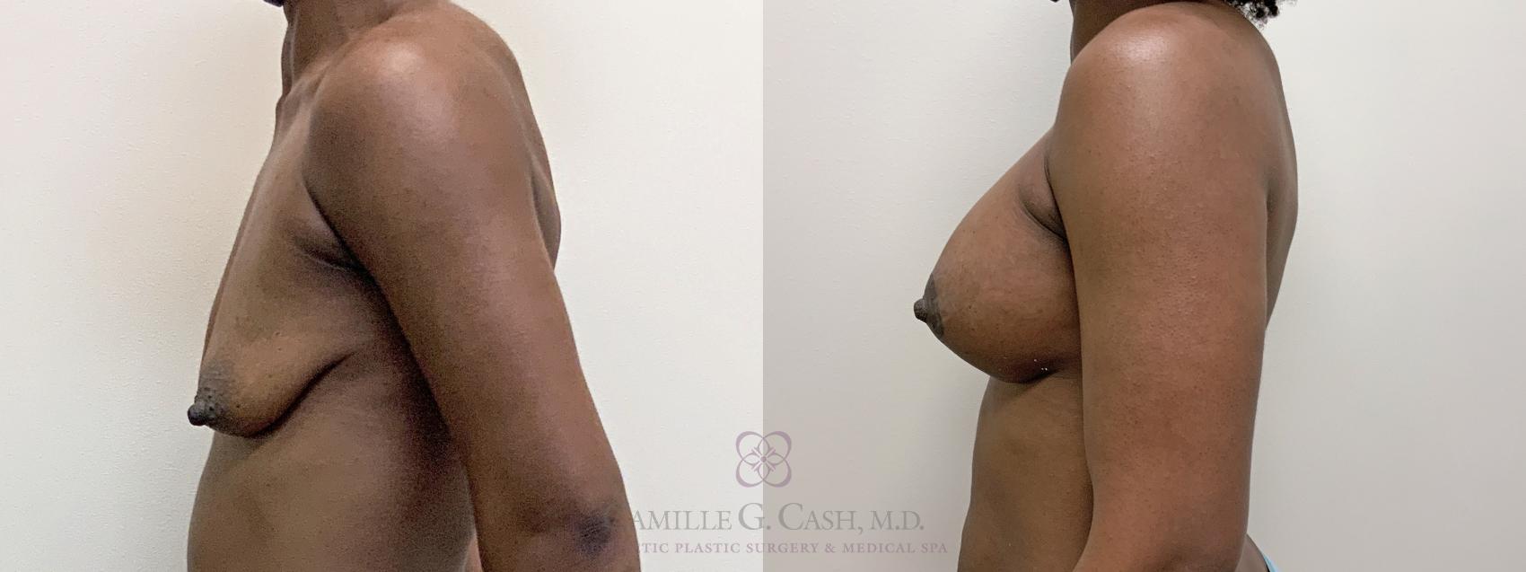 Before & After Breast Lift with Implants Case 485 Right Side View in Houston, TX
