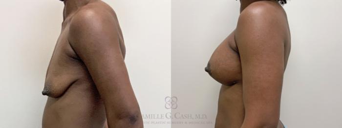 Before & After Breast Lift with Implants Case 485 Right Side View in Houston, TX