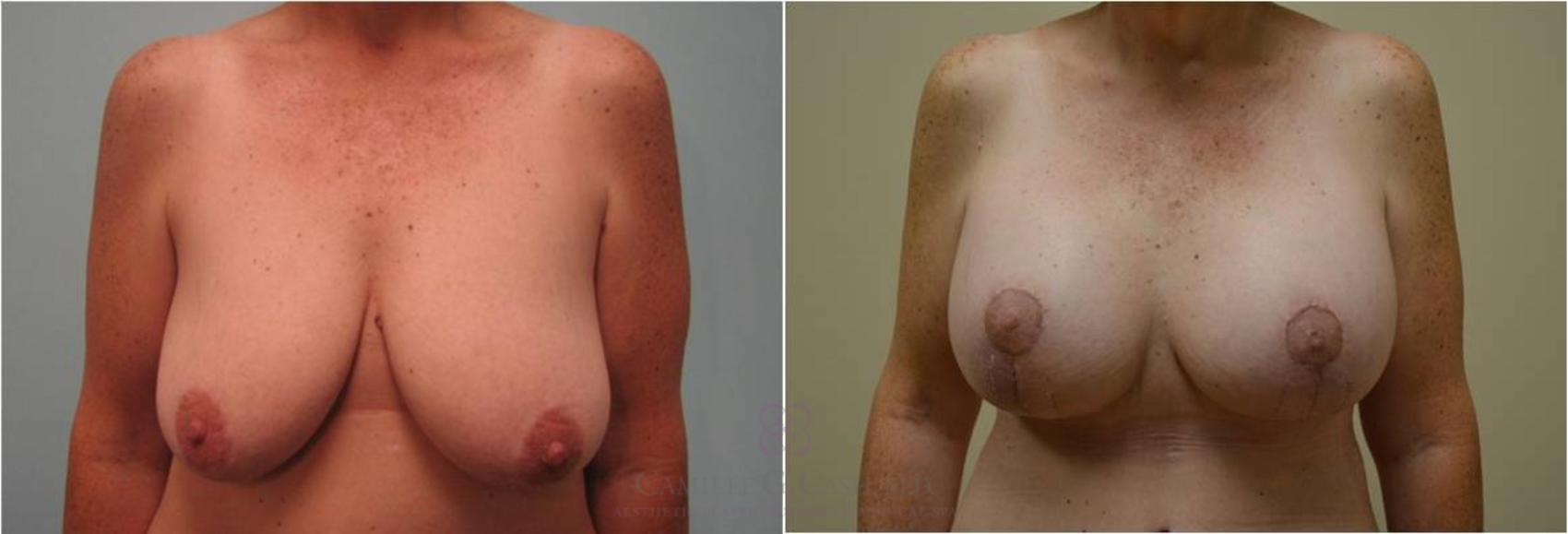 Before & After Breast Lift with Implants Case 56 View #1 View in Houston, TX