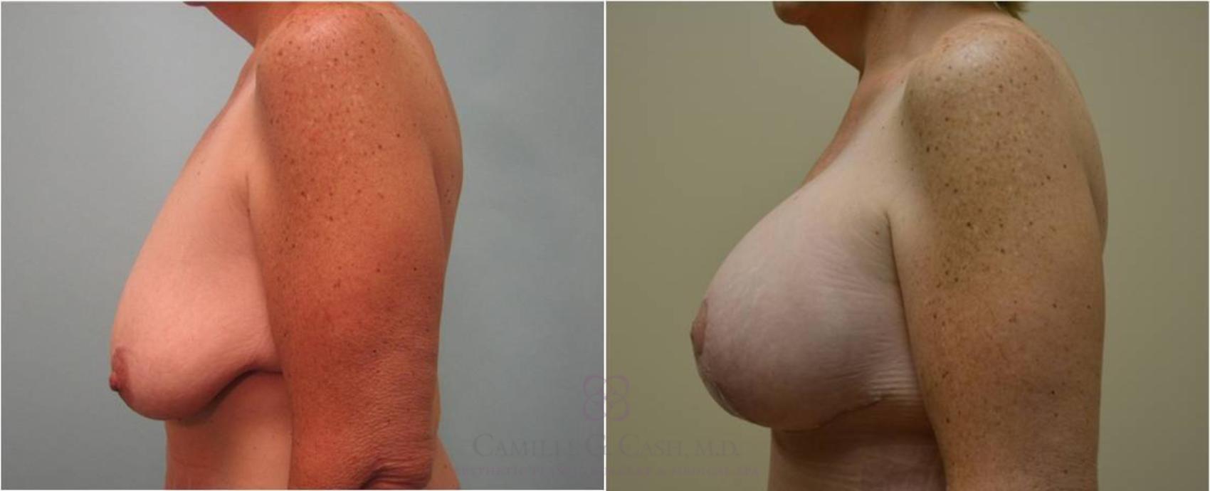 Before & After Breast Lift with Implants Case 56 View #2 View in Houston, TX