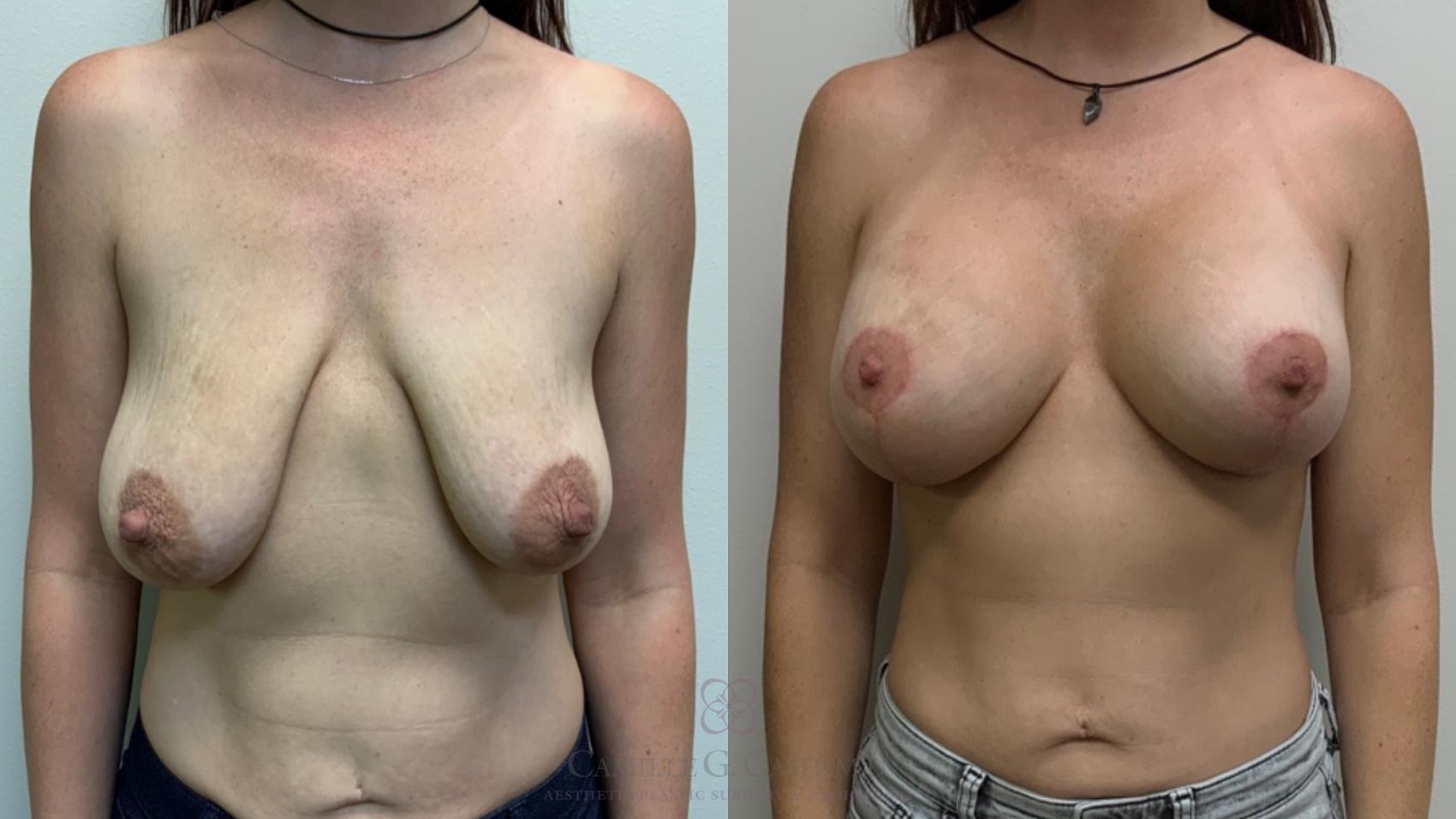 Before & After Post-Weight Loss Breast Enhancement Case 571 Front View in Houston, TX