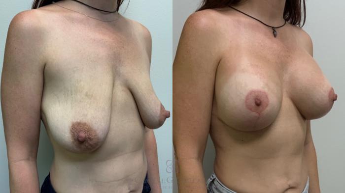 Before & After Post-Weight Loss Breast Enhancement Case 571 Left Oblique View in Houston, TX