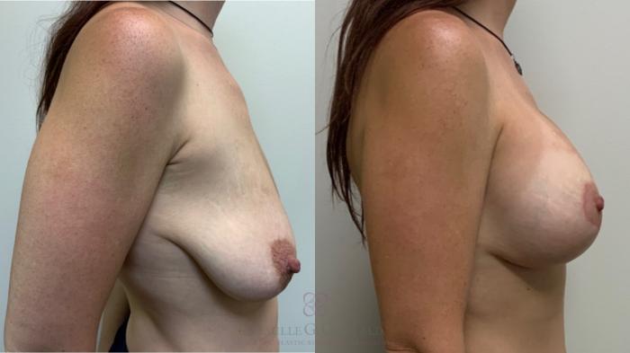 Before & After Breast Lift with Implants Case 571 Left Side View in Houston, TX