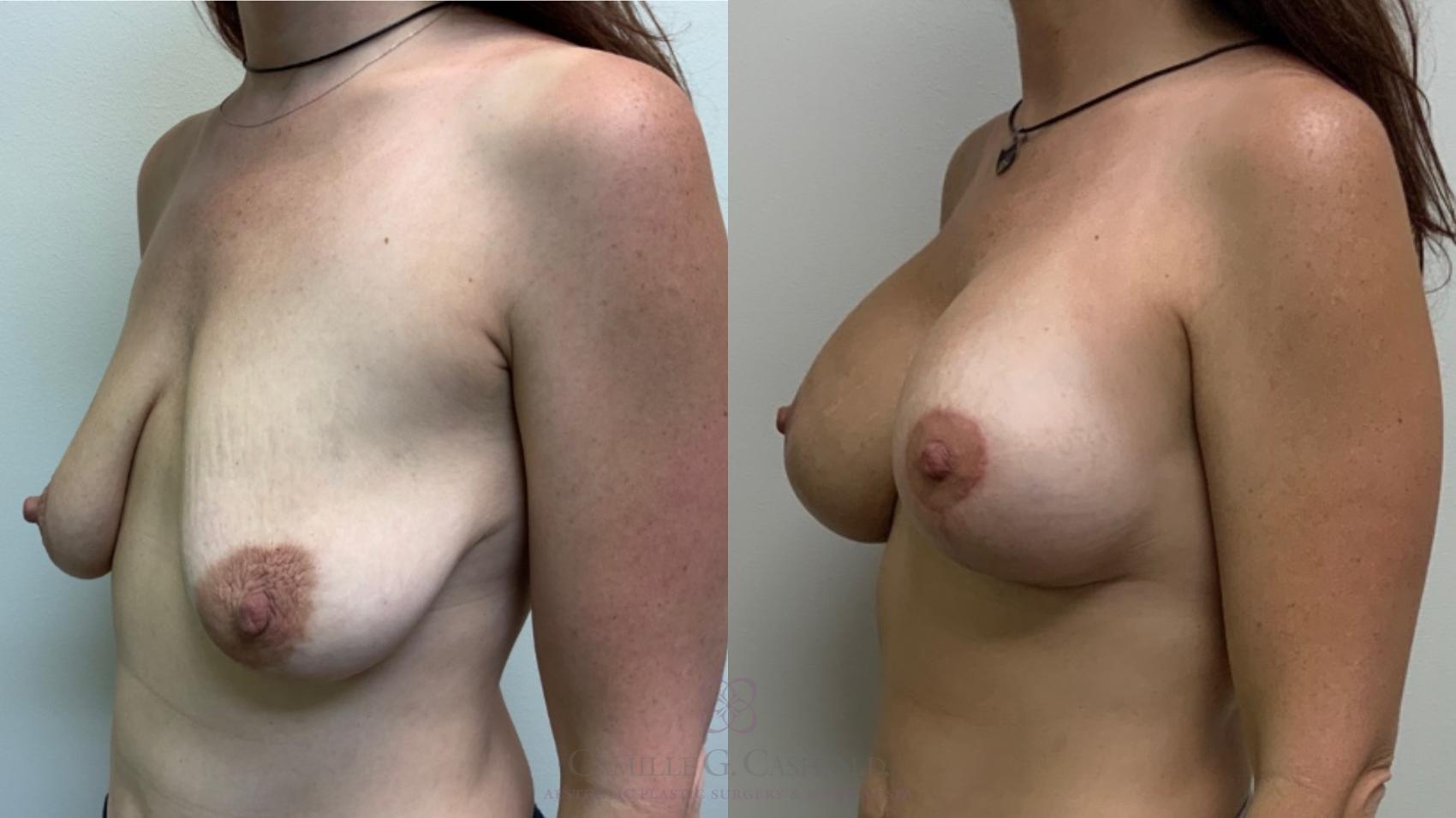 Before & After Breast Lift with Implants Case 571 Right Oblique View in Houston, TX