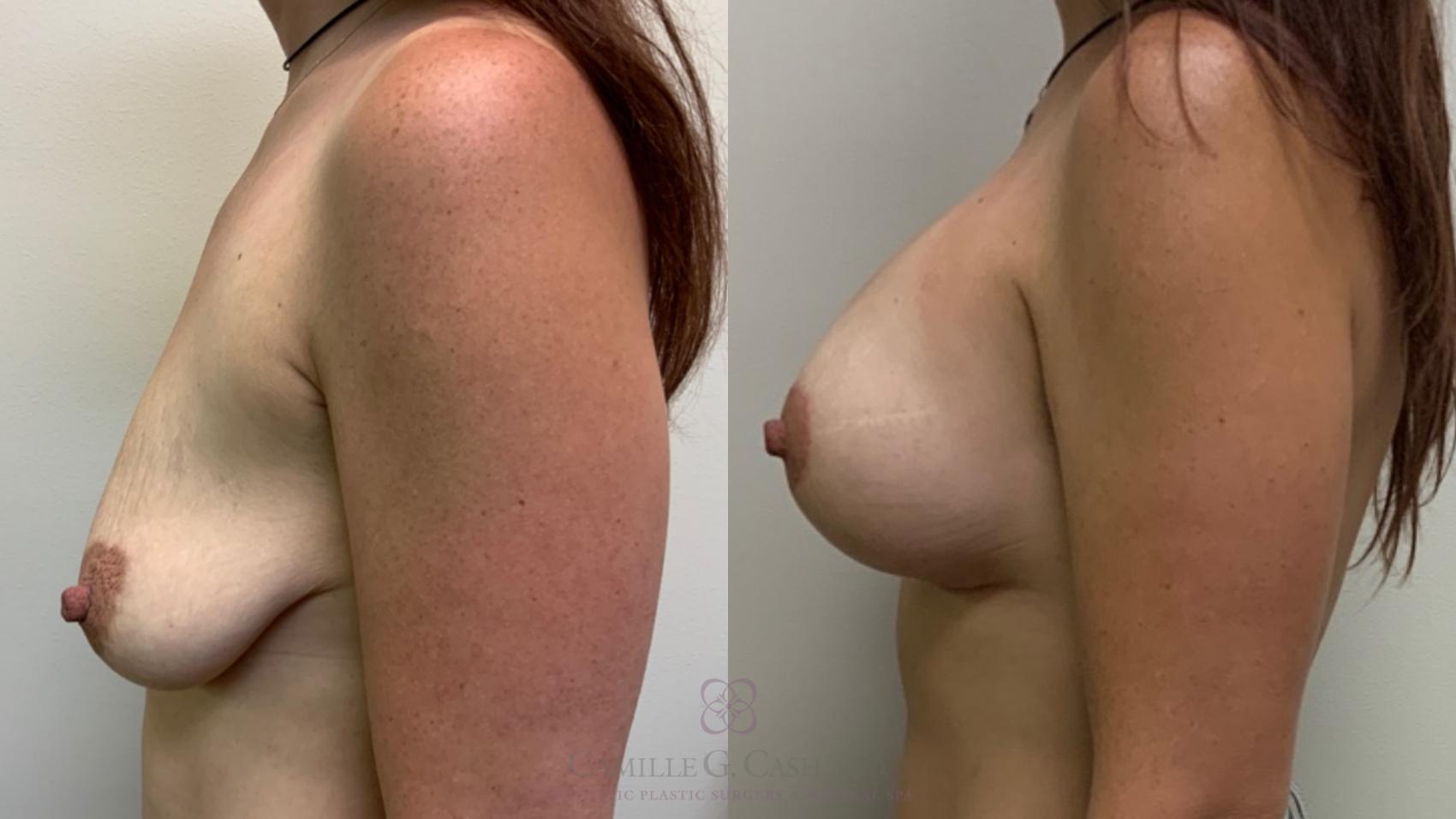 Before & After Breast Lift with Implants Case 571 Right Side View in Houston, TX