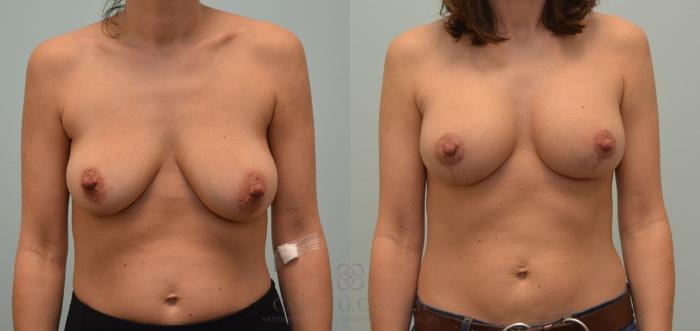 Before & After Breast Lift with Implants Case 61 View #1 View in Houston, TX