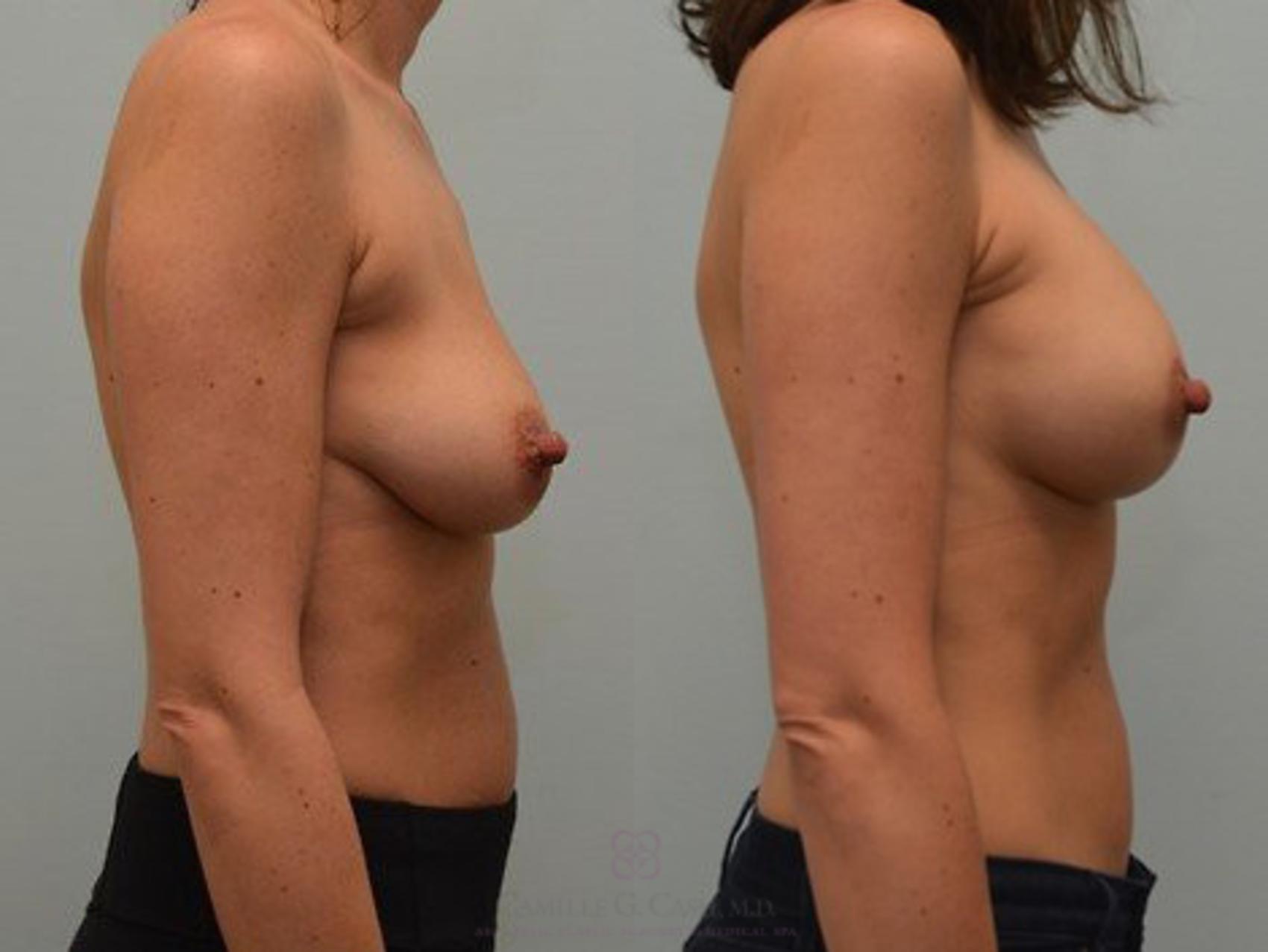 Before & After Breast Lift with Implants Case 61 View #3 View in Houston, TX