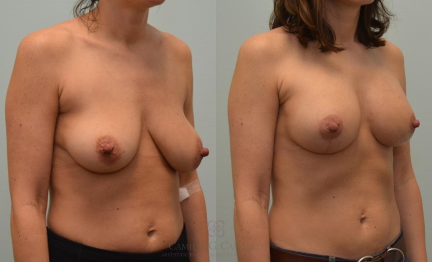 Before & After Breast Lift with Implants Case 61 View #6 View in Houston, TX