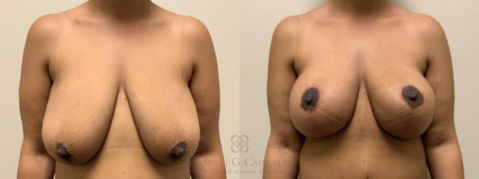 Before & After Breast Lift with Implants Case 647 Front View in Houston, TX