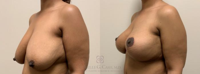 Before & After Breast Lift with Implants Case 647 Left Oblique View in Houston, TX