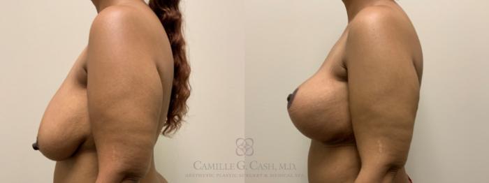 Before & After Breast Lift with Implants Case 647 Left Side View in Houston, TX