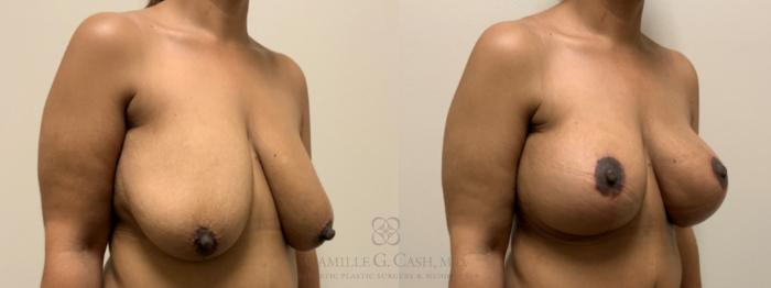 Before & After Breast Lift with Implants Case 647 Right Oblique View in Houston, TX