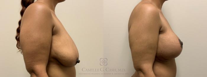 Before & After Breast Lift with Implants Case 647 Right Side View in Houston, TX