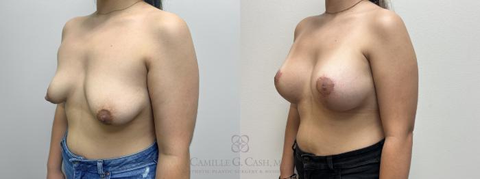 Before & After Breast Lift with Implants Case 663 Left Oblique View in Houston, TX