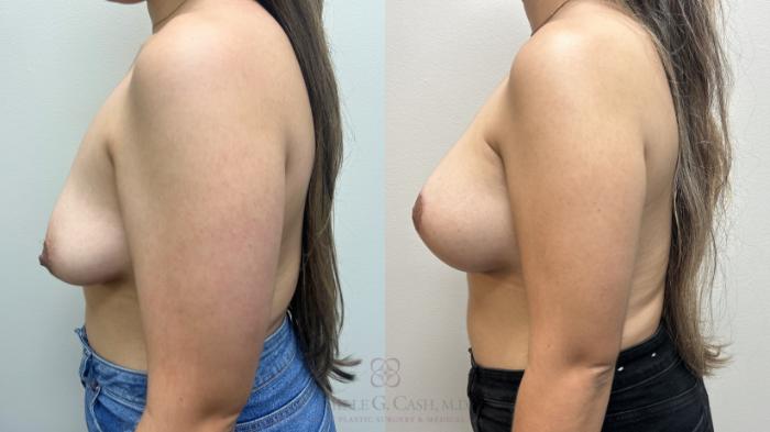 Before & After Breast Lift with Implants Case 663 Left Side View in Houston, TX