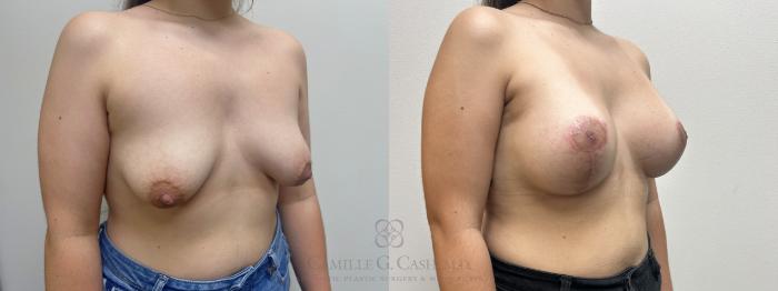 Before & After Breast Lift with Implants Case 663 Right Oblique View in Houston, TX