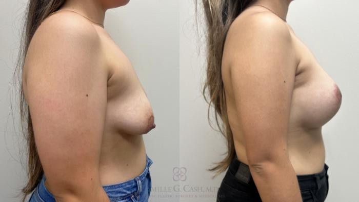Before & After Breast Lift with Implants Case 663 Right Side View in Houston, TX