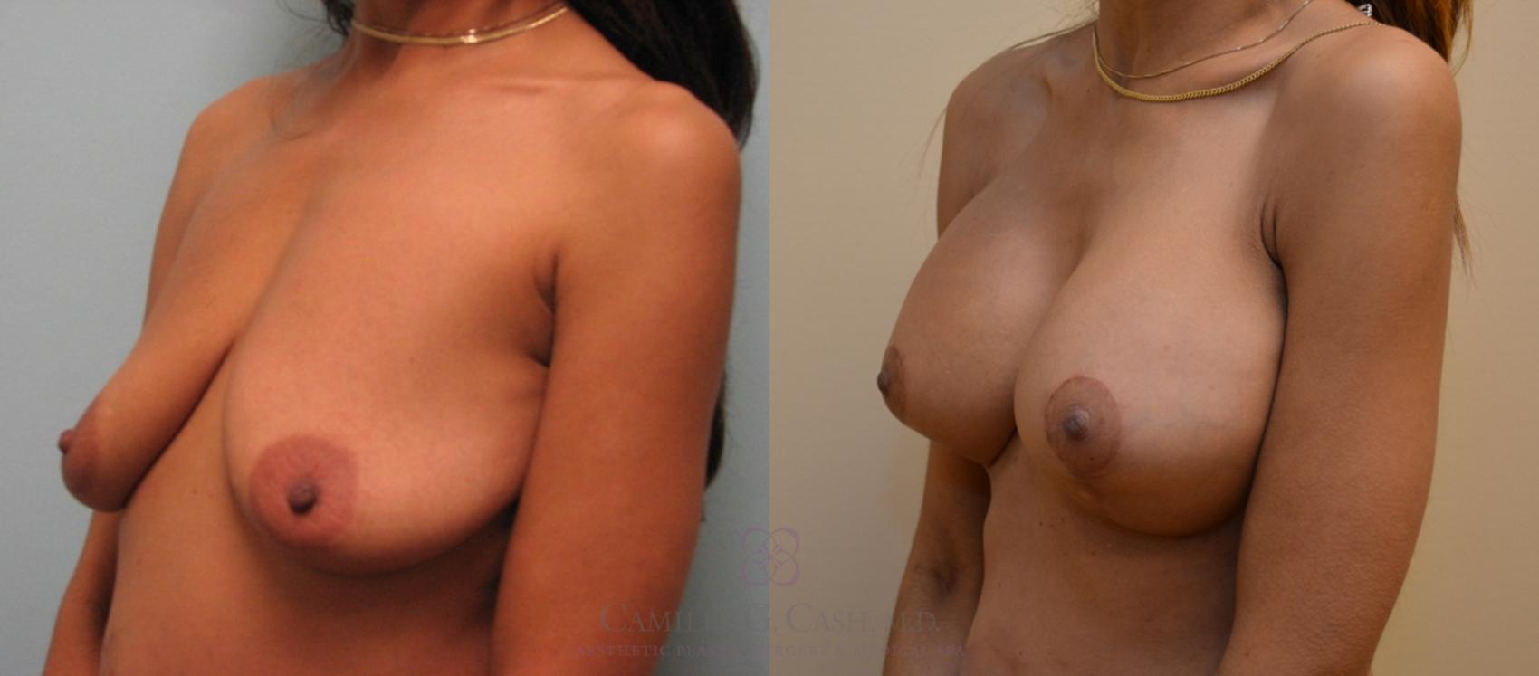 Before & After Breast Lift with Implants Case 77 View #1 View in Houston, TX