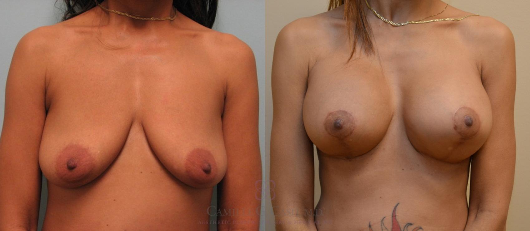Before & After Breast Lift with Implants Case 77 View #3 View in Houston, TX