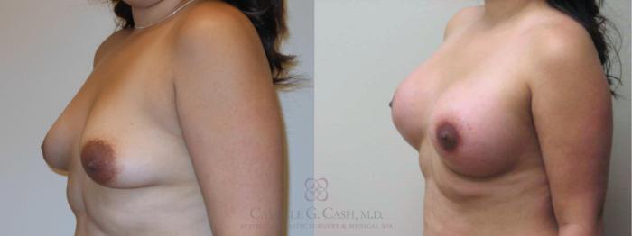 Before & After Breast Lift with Implants Case 79 Left Oblique View in Houston, TX