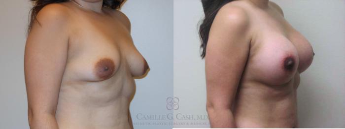 Before & After Breast Lift with Implants Case 79 Right Oblique View in Houston, TX