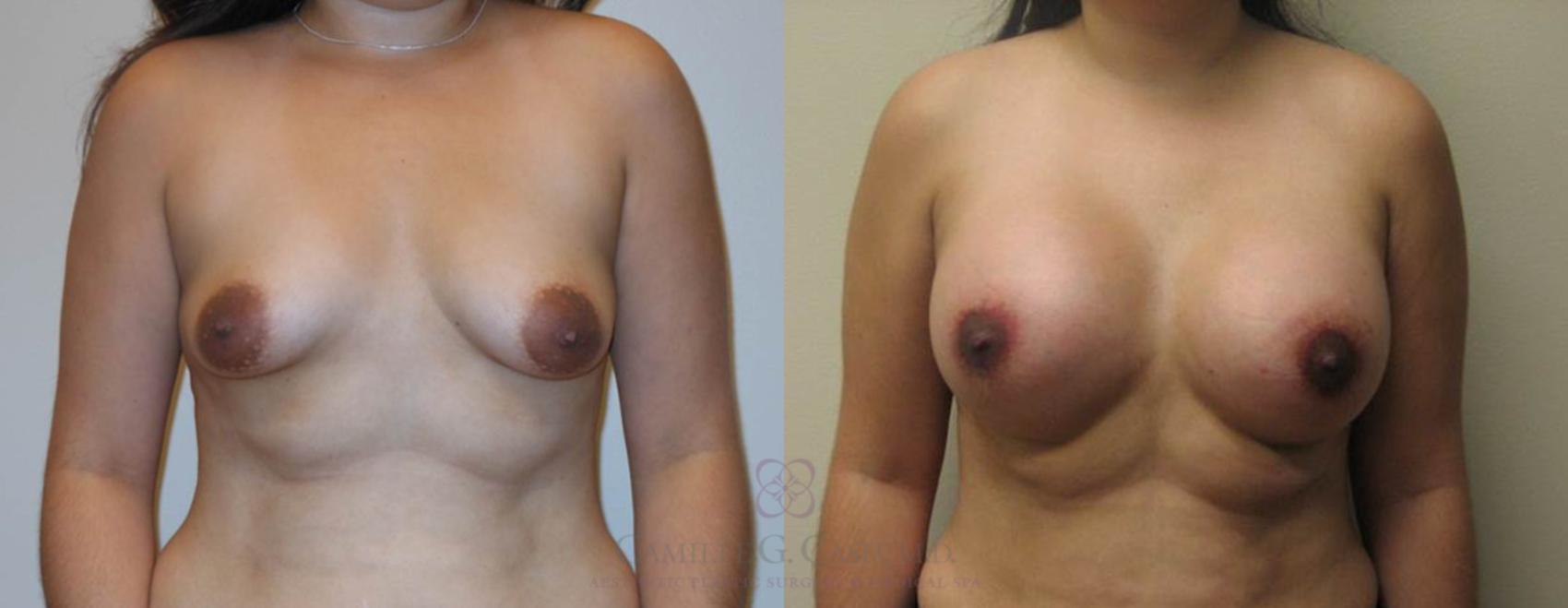 Before & After Breast Lift with Implants Case 79 View #1 View in Houston, TX