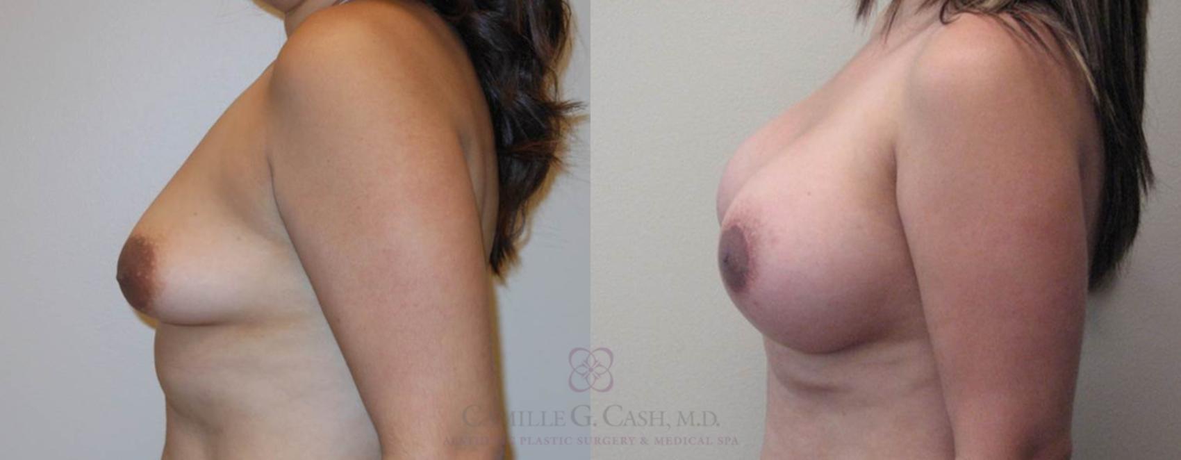 Before & After Breast Lift with Implants Case 79 View #2 View in Houston, TX
