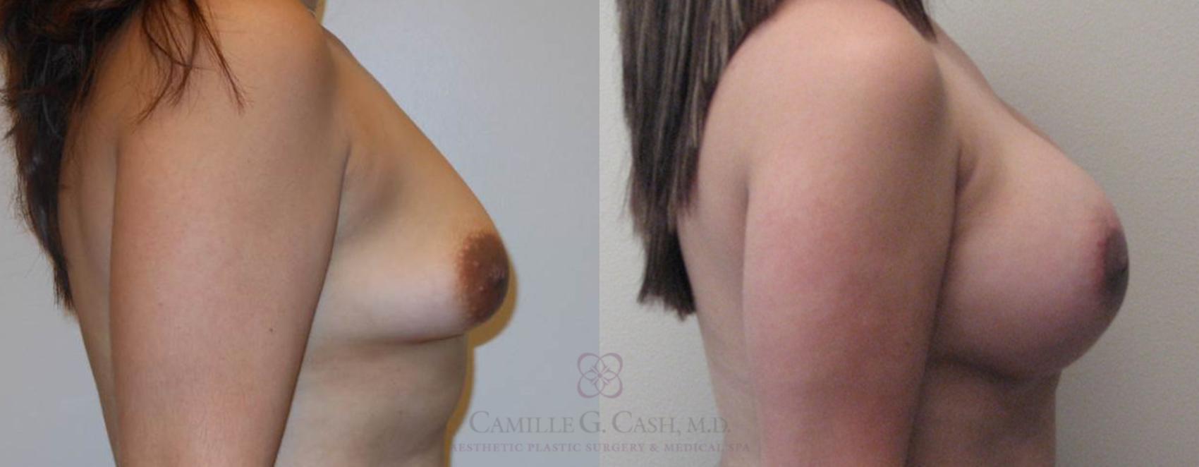 Before & After Breast Lift with Implants Case 79 View #3 View in Houston, TX
