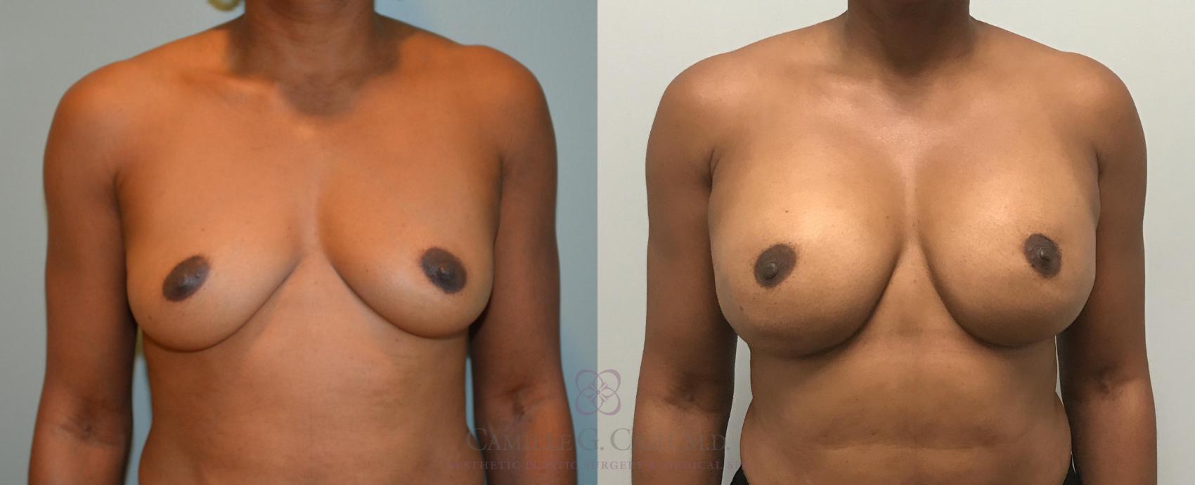 Before & After Breast Reconstruction Case 378 View #1 View in Houston, TX