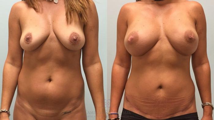 Before & After Mini Tummy Tuck Case 455 Front View in Houston, TX