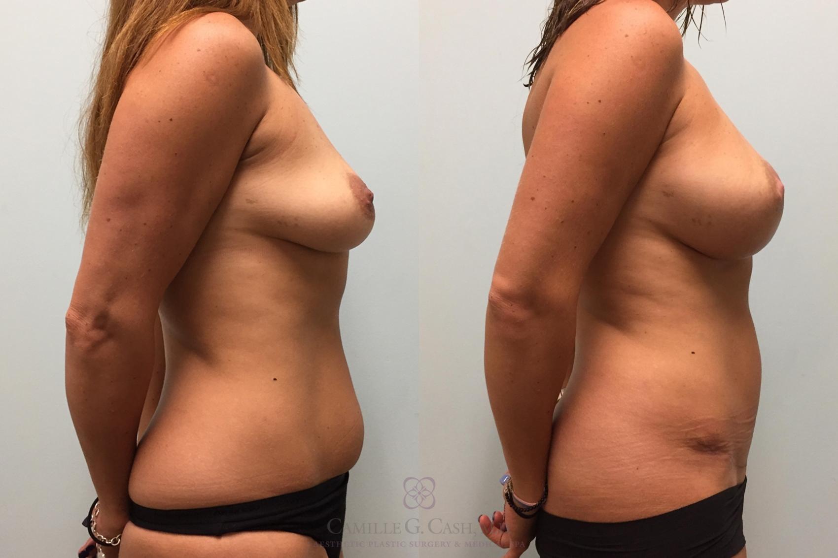 Before & After Breast Reconstruction Case 455 Left Side View in Houston, TX