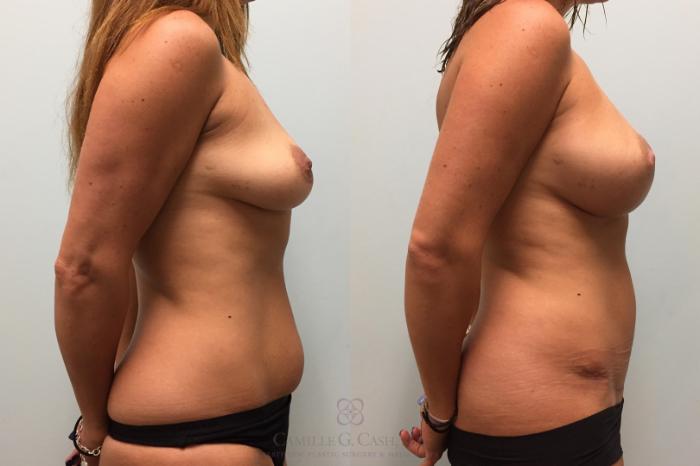 Before & After Mini Tummy Tuck Case 455 Left Side View in Houston, TX