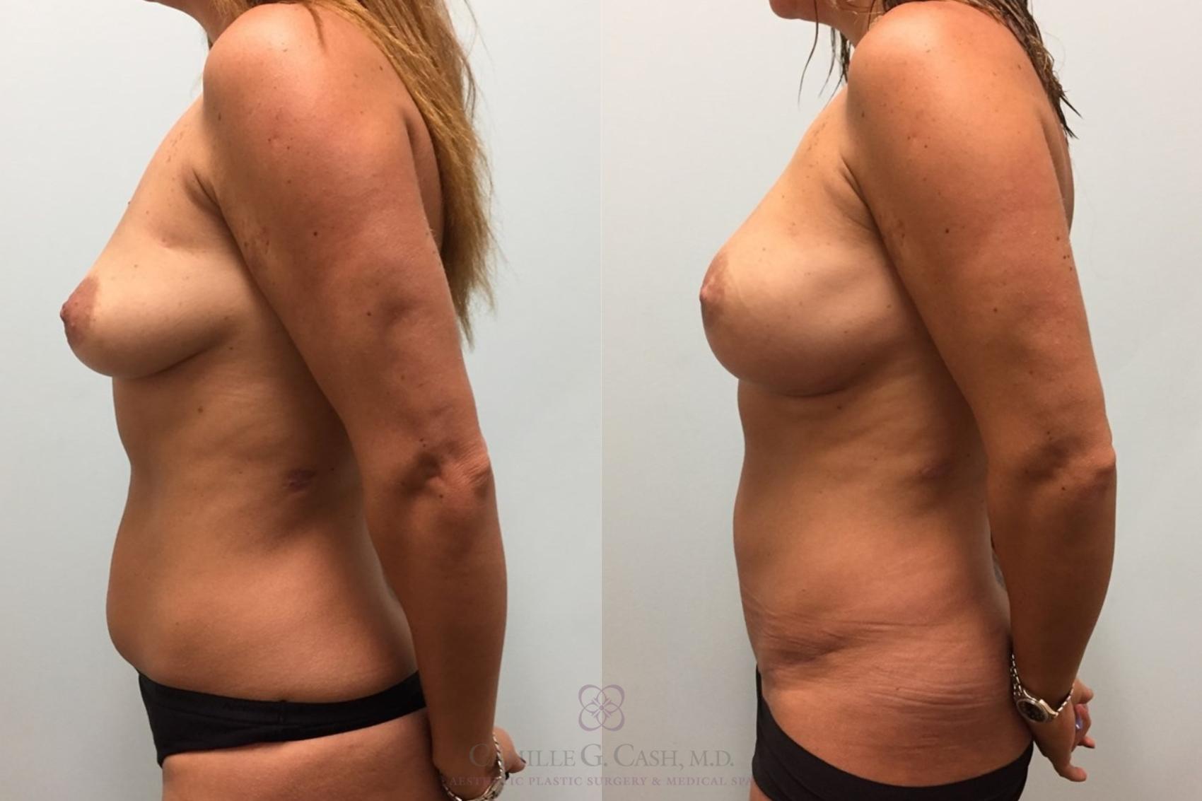 Before & After Breast Reconstruction Case 455 Right Side View in Houston, TX