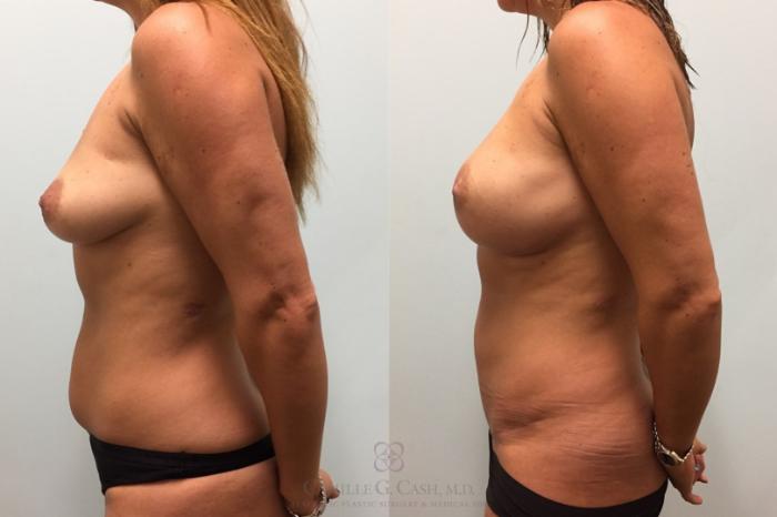 Before & After Mini Tummy Tuck Case 455 Right Side View in Houston, TX