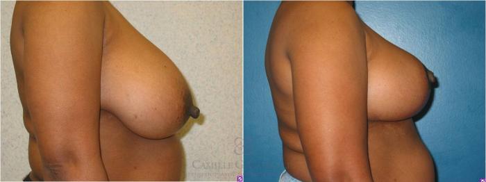 Before & After Breast Reduction Case 11 View #1 View in Houston, TX