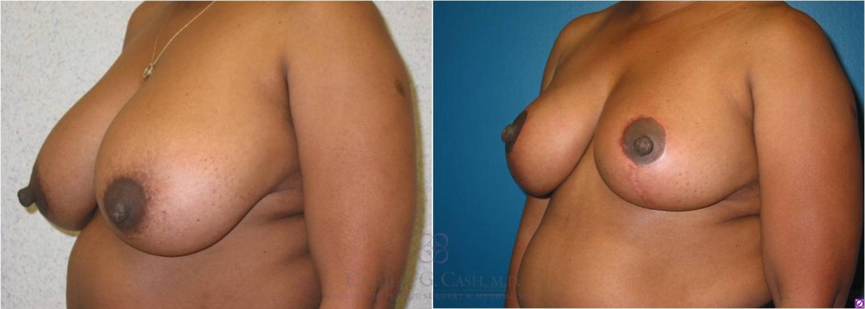 Before & After Breast Reduction Case 11 View #2 View in Houston, TX