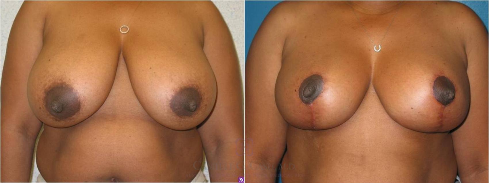 Before & After Breast Reduction Case 11 View #3 View in Houston, TX