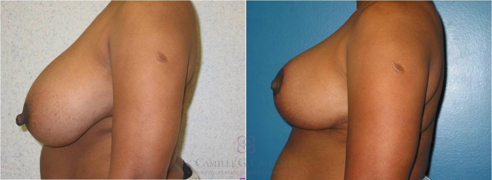 Before & After Breast Reduction Case 11 View #4 View in Houston, TX