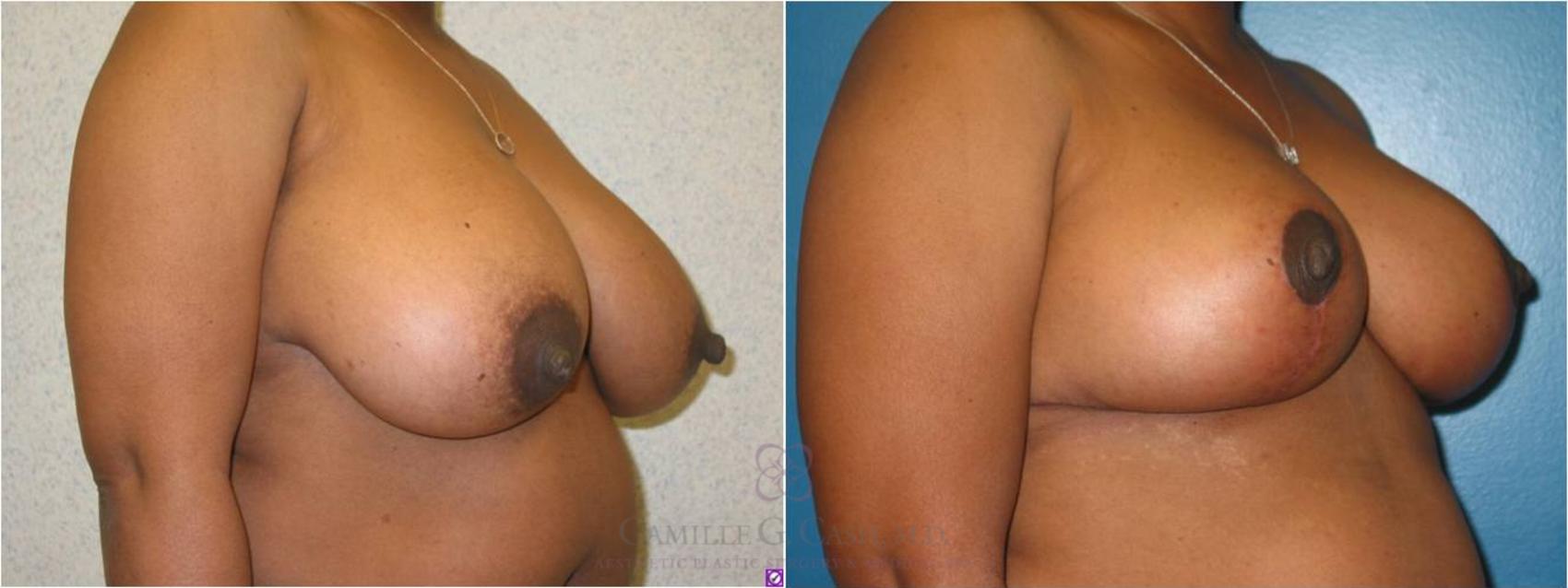 Before & After Breast Reduction Case 11 View #5 View in Houston, TX