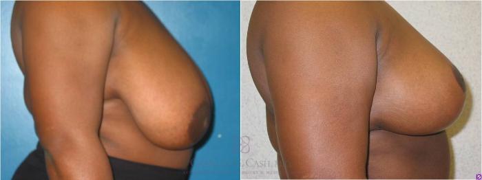 Before & After Breast Reduction Case 16 View #1 View in Houston, TX