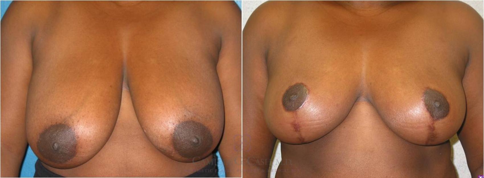 Before & After Breast Reduction Case 16 View #2 View in Houston, TX